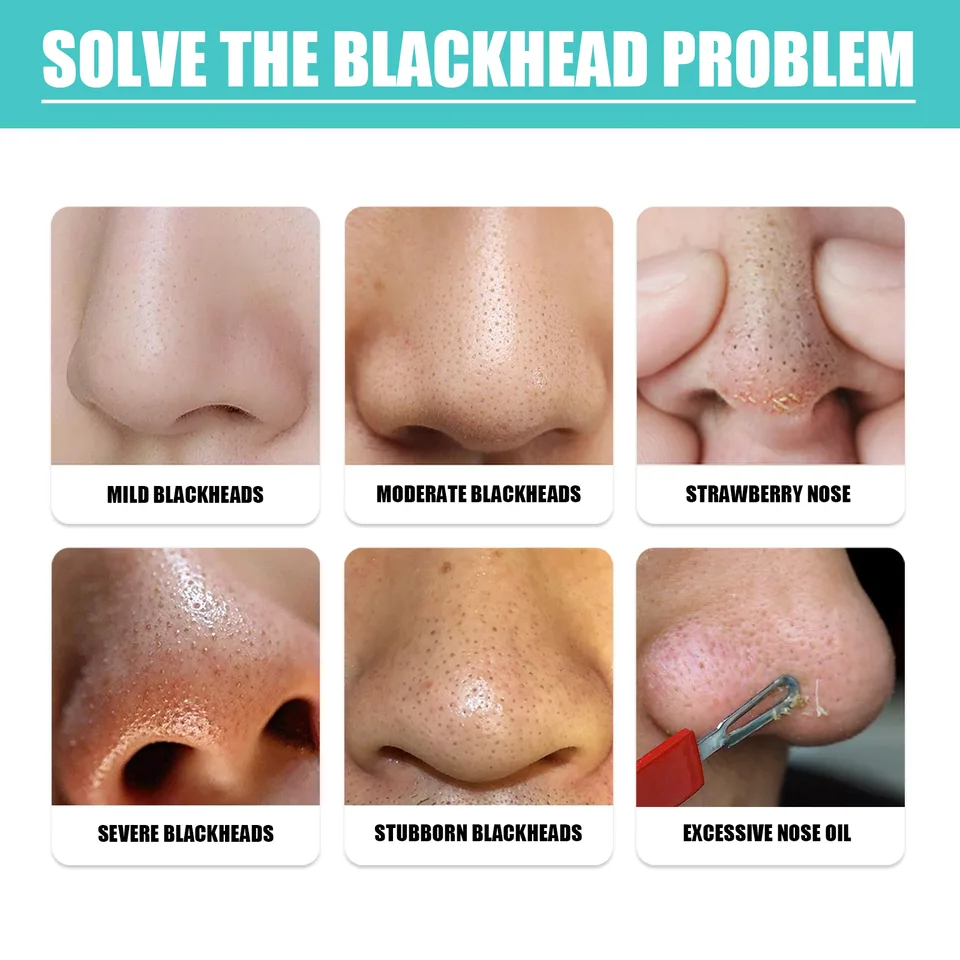 EELHOE Blackhead Nose Mask Moisturizes And Smoothes The Skin, Removes Blackheads From Acne And Deeply Cleans Pores And Dirt view 5